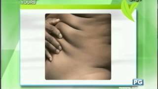 Natural Ways to Prevent Skin Problems Related to Obesity