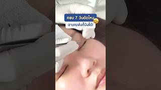 ครบ 7 วันตัดไหม ตาสวยหวานมาก! #inzclinic #inZeye #ศัลยกรรมตา #จักษุแพทย์ #ทำตาสองชั้น