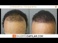 2501fue grafts. iii vertex. afro hair. surgical procedure. 5 months. injertocapilar.com.2701 2021