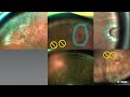 od os navilas® laser real time navigatie. dé innovatie voor retinale laserbehandeling