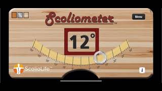Scoliometer App 2021 Update for Scoliosis Monitoring