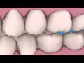 AAE Cracked Teeth Video