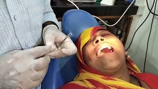 Painless removal of RC treated upper left first molar surgically #painlesstreatment #dentistry