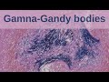 What are Gamna-Gandy Bodies? - Pathology mini tutorials