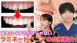 歯並びも治せるラミネートべニア！今までに施術した症例を紹介!【歯を白くする方法】