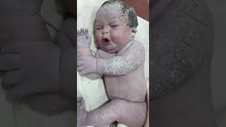 Beautiful Chubby Newborn baby immediately after birth with Down syndrome
