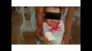 KAPAMPANGAN DEVELOPMENT FOUNDATION HARELIP-CLEFT 22 MAY 2012.wmv