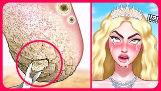 Queen's Foot Corns and Thick Calluses Removal!👑 Satisfying ASMR Animation