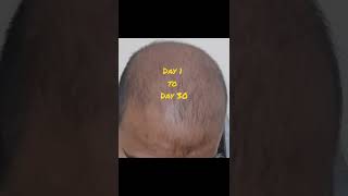 Neo Hair Lotion 30 days Result | Neo Hair Lotion Result Day 1 to Day 30 | How to use neo hair lotion