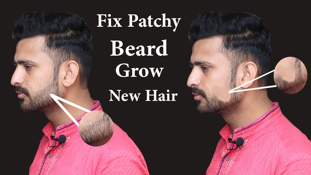 Naturally Fast Fix Patchy Beard At Home | Fix Patchy & Growth Beard New ...