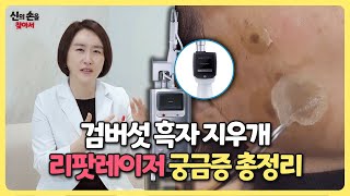 검버섯 흑자 지우개 리팟 레이저 궁금증 총정리 (ft.사기 절대 아닙니다.)