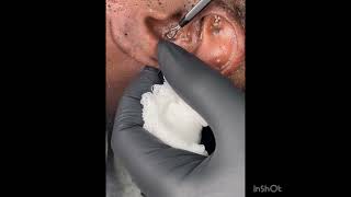 Pimple, zit, cyst, spot, blackhead compilation 2023 #acne #newvideo #viral