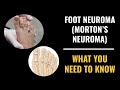 Foot Neuroma (Morton's Neuroma) - What you need to know