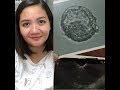 Our IVF Success Story - Kato | Price | Journey (Philippines)