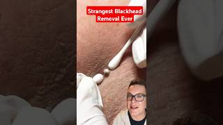 Strangest BLACKHEAD REMOVAL Ever - What Is This #shorts