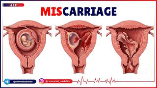 32. Miscarriage | Obstetrics & Gynecology for USMLE Step 2 CK | Types, Diagnosis & Management