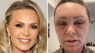 11 Real Housewives Plastic Surgery Gone Horribly Wrong