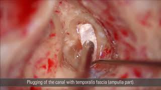 ENT surgery with the M530 OHX: Transmastoid plugging of the superior semicircular canal