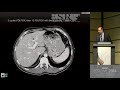 GI - Colorectal cancer liver metastases   Assessing tumour response 3