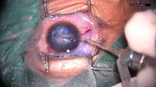 Traumatic Pediatric Cataract Management  (Unedited) HD