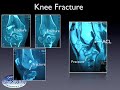 treatment of a knee fracture tibial plateau in a patient with an acl reconstruction