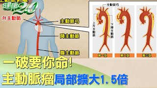 一破要你命！主動脈瘤好發4部位局部擴大1.5倍 健康2.0