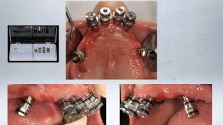 Cortex Dental Implants: Multi Unit System