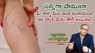 ఉబ్బిన సిరలు ఎలా గుర్తుపట్టాలి | How Can we Find Varicose Veins  | Dr.Rajesh