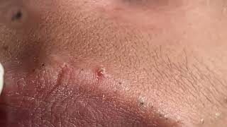 از بین بردن جوش صورت در یک روز یا یک شب Eliminate facial pimples in a day or one night