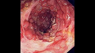 GI-GU: (Wk10)(Tues)(Win21): Prostatitis & Crohn's Disease I and Its related enteropathic arthropathy