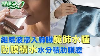 組織液滲入肺臟釀肺水腫 肋膜積水水分積肋膜腔 健康2.0 @tvbshealth20