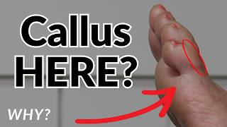 Callus on Your Pinky Toe? Here’s What It REALLY Means