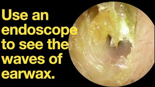 Use an endoscope to see the waves of earwax.|ear wax removal | ear cleaning | ASMR | relaxation