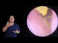 ear wax removal from the valley ep444