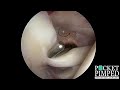 the basics of shoulder arthroscopy