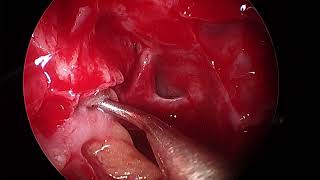 Endoscopic repair of CSF rhinorrhea