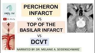 Percheron art infarct VS top of the basilar VS venous thrombosis