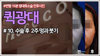 퀵광대 방식의 변형15분 광대축소술- (10) 수술 후 2주 멍과 붓기 feat.전후사진