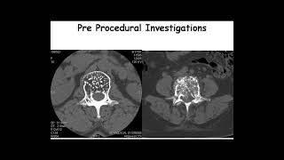 Vertebroplasty: Casus \u0026 Treatment