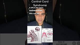 Central cord syndrome