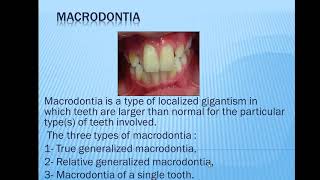 38-Types of macrodontia