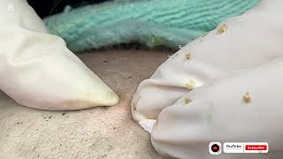 Big Cystic Acne Blackheads Extraction Blackheads \u0026 Milia, Whiteheads Removal Pimple Popping