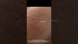 รักษาหลุมสิว Boxcar + Ice pick acne scar + Fibrosis Discovery Pico Laser +Subcision +Exosomes