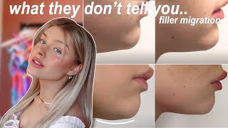 chin filler 3 years later | filler migration, what they don't tell you..