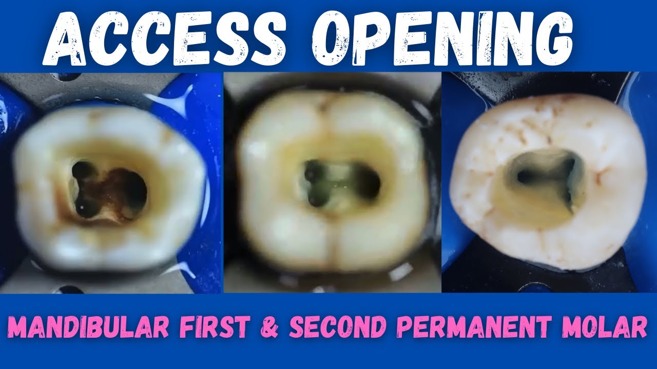 Mandibular First Molar Canals Root Canal Morphology Of Permanent