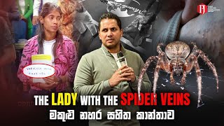 The LADY with The SPIDER VEINS | මකුළු නහර සහිත කාන්තාව