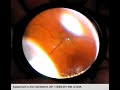 predictive value of pre plus disease in retinopathy of prematurity part 3