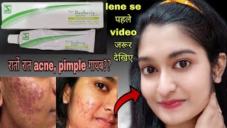 Topi Berberies Cream Review | For pimples, acne ,dark spots n wrinkles | indigenous beauty