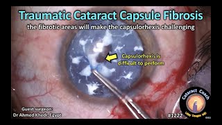 CataractCoach 1222: traumatic cataract capsule fibrosis