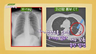 'X-ray' 촬영과 엄연히 다른 '저선량 흉부 CT' 검사의 장점 👉🏻 맛있는 이야기 미라클 푸드(Miracle Food) 78회 | JTBC 20200919 방송